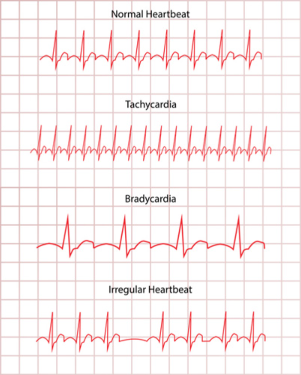 How To Perform ECG Categorization And Detect Arrhythmia KNIME