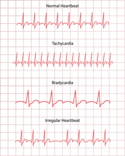 Multiclass ECG classification with KNIME